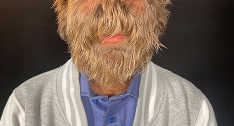 O Jovem com o Rosto Mais Peludo do Mundo: A História Inspira